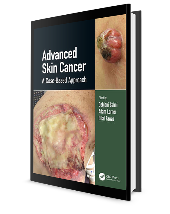 Advanced Skin Cancer