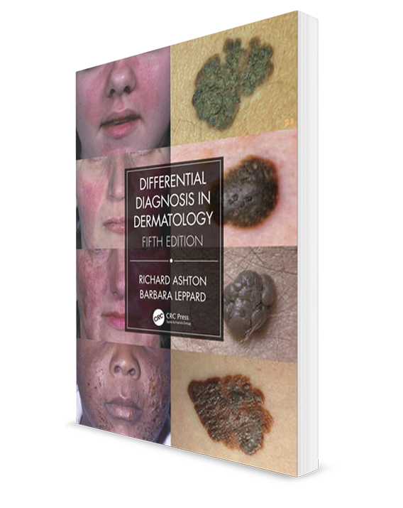 Differential Diagnosis in Dermatology